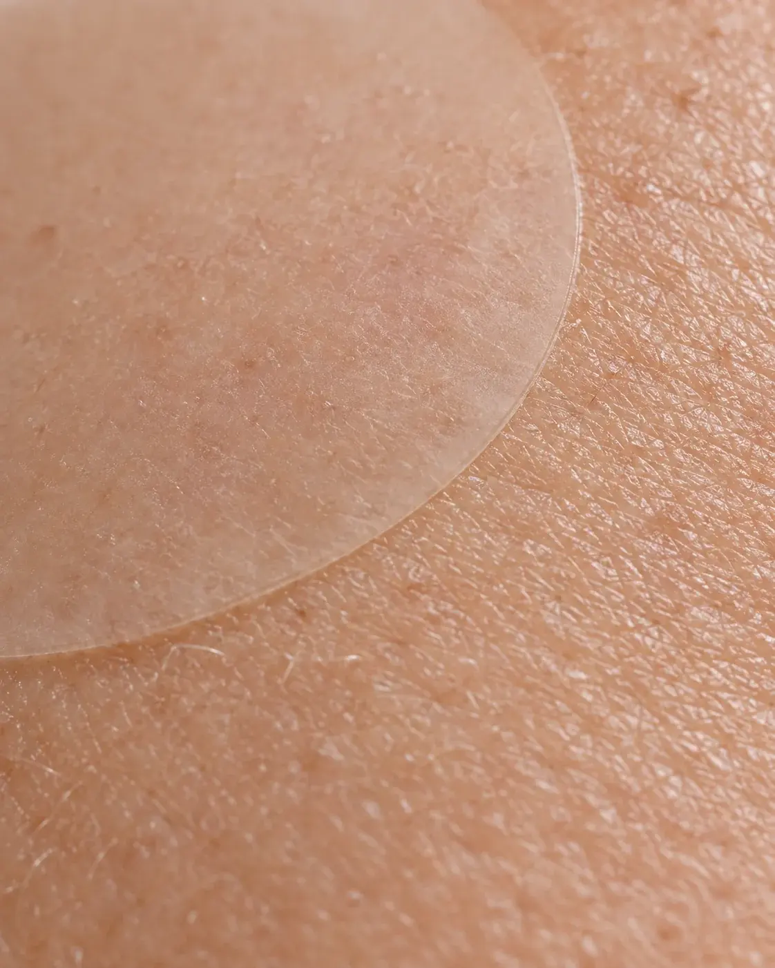 Close-up photograph of the edge of a translucent ClearSkin Labs spot patch worn on skin